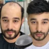 Men's Hair Systems